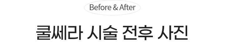Before & After 쿨쎄라 시술 전후 사진