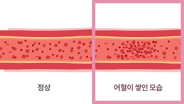 정상/어혈이 쌓인 모습